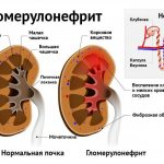 Гломерулонефрит