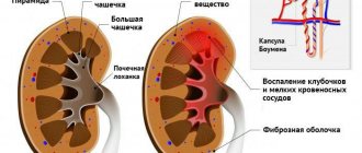 Гломерулонефрит